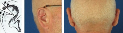 Chirurgie dermatologique de l'oreille