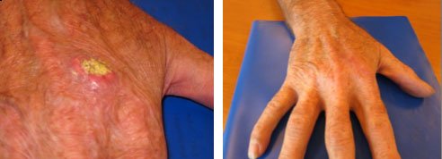Chirurgie dermatologique des mains avant / après