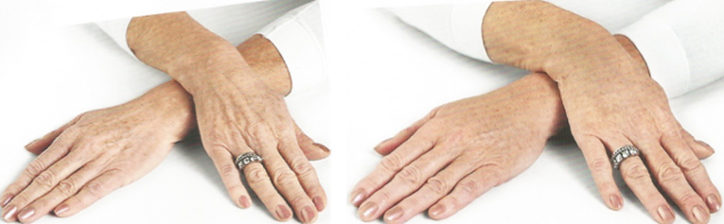 Rajeunissement des mains par injections d'acide hyaluronique