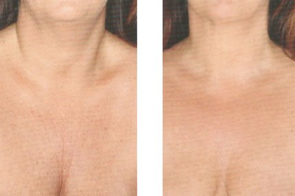 Rajeunissement du décolleté par injections d'acide hyaluronique