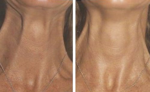 Rajeunissement du cou par injections de botox