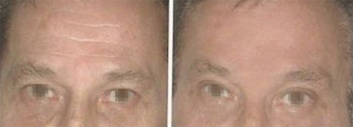 Rajeunissement du front par injections de Botox