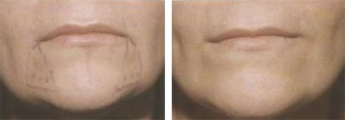 Rendre le sourire par injections de Botox