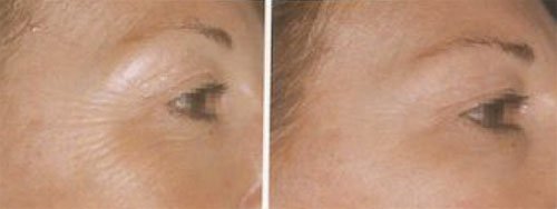 Traitement des rides autour des yeux par injection de Botox